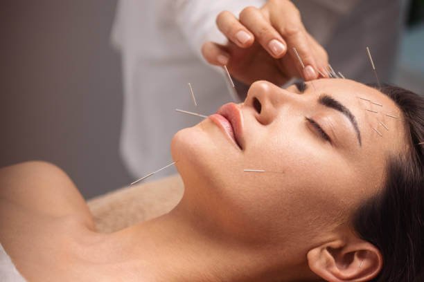 facial acupuncture near me