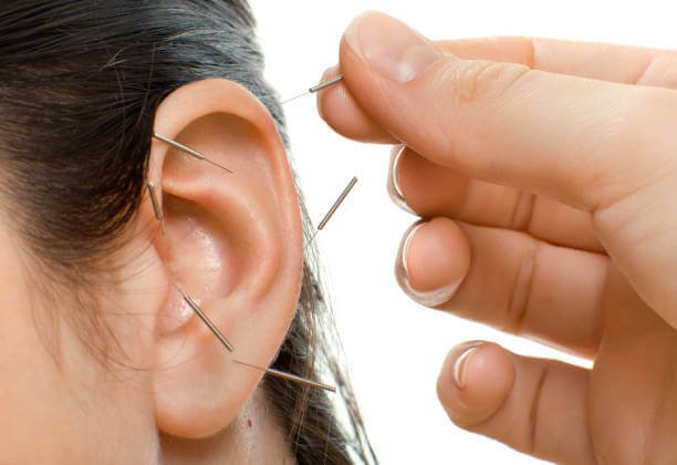 Ear acupuncture