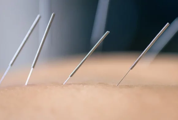 acupuncture gurnee