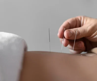 acupuncture vs dry needling