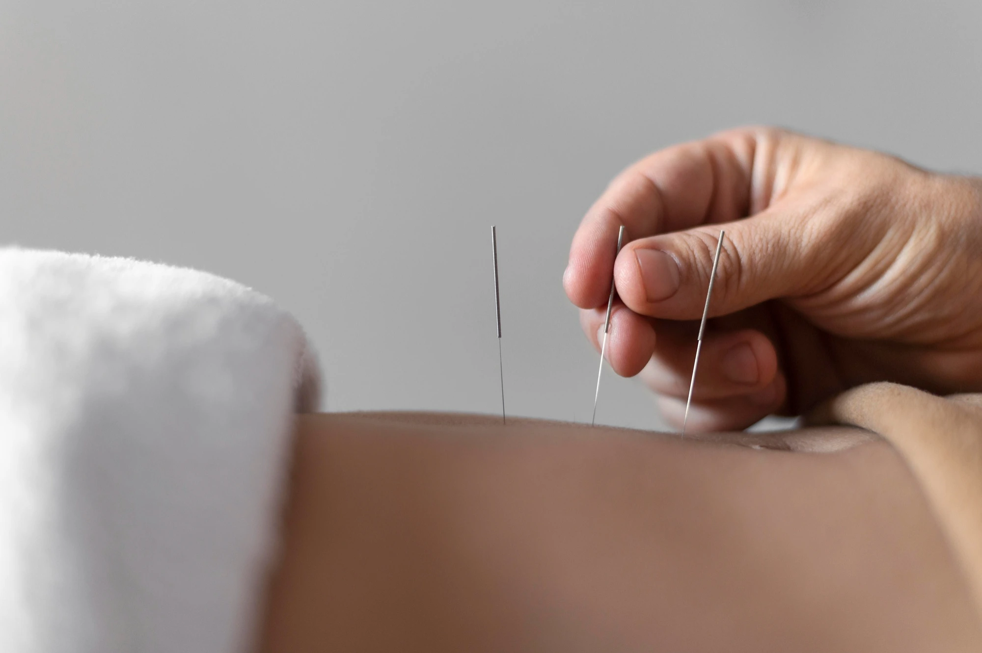 acupuncture vs dry needling