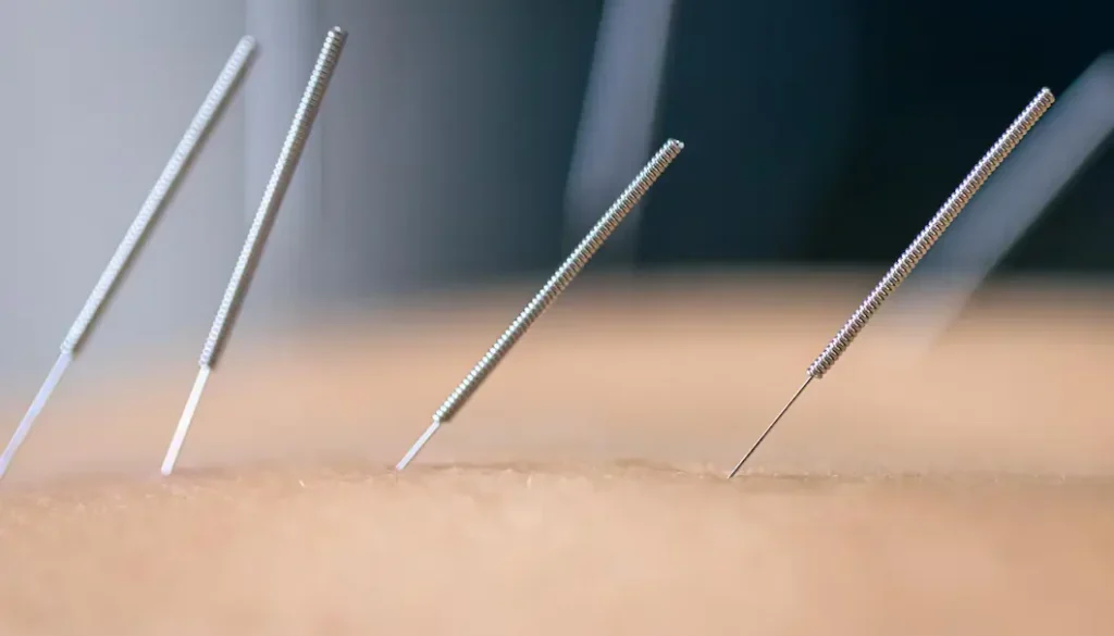 acupuncture benefits