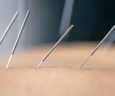 acupuncture benefits