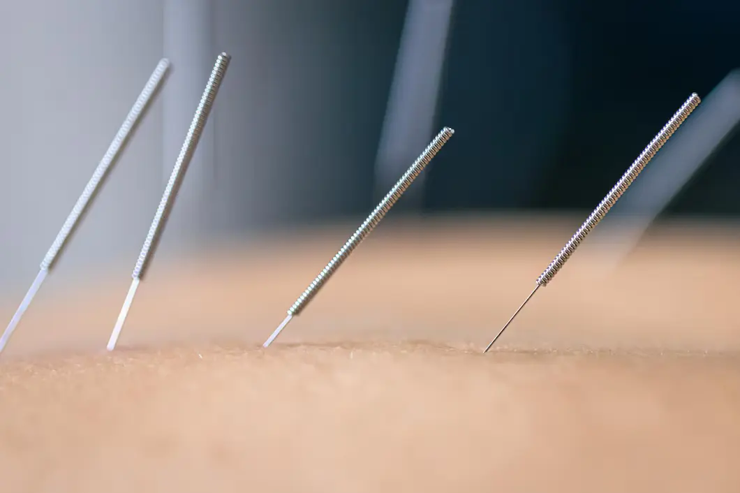 acupuncture benefits