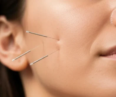 acupuncture for tmj